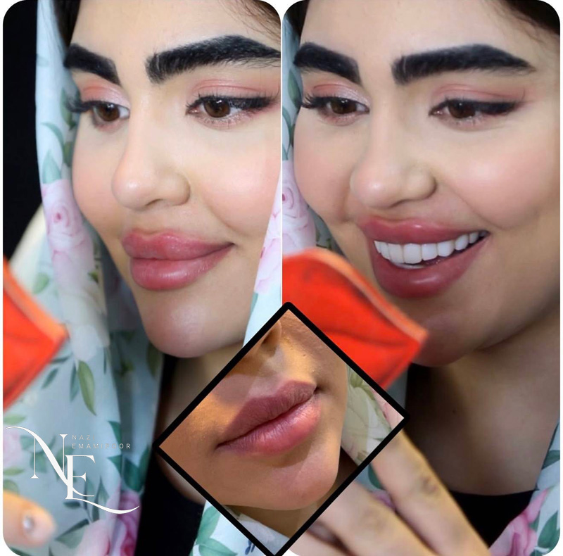 عکس تغییرات چهره و فرم طبیعی لب ها هنگام لبخند زدن پس از تزریق ژل لب روسی