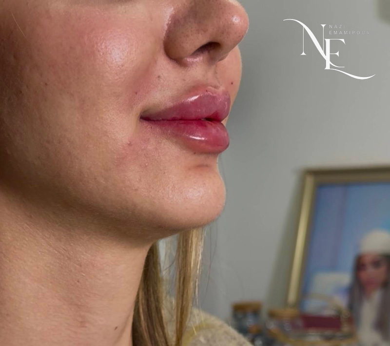عکس نمای نیم رخ از نتیجه تزریق ژل لب روسی و اصلاح فرم لب ها