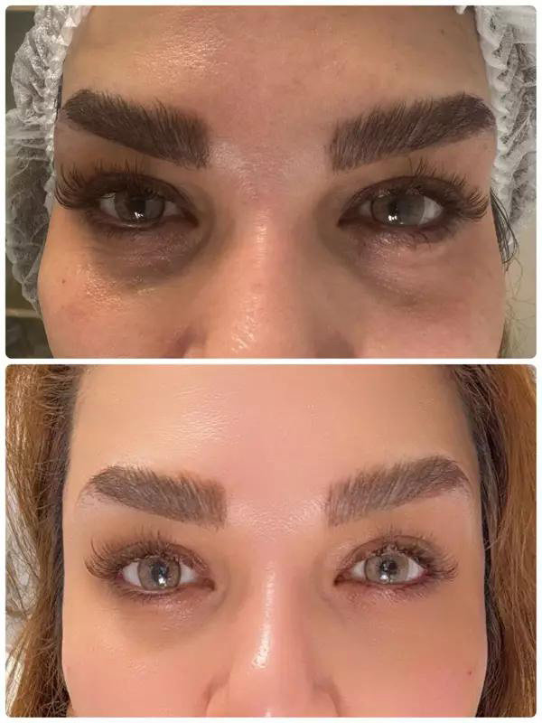 عکس قبل و بعد تزریق فیلر شقیقه برای رفع گودی و لیفت چشم و ابرو