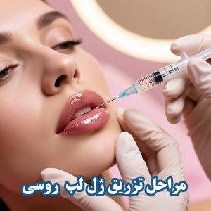 مراحل تزریق ژل لب روسی