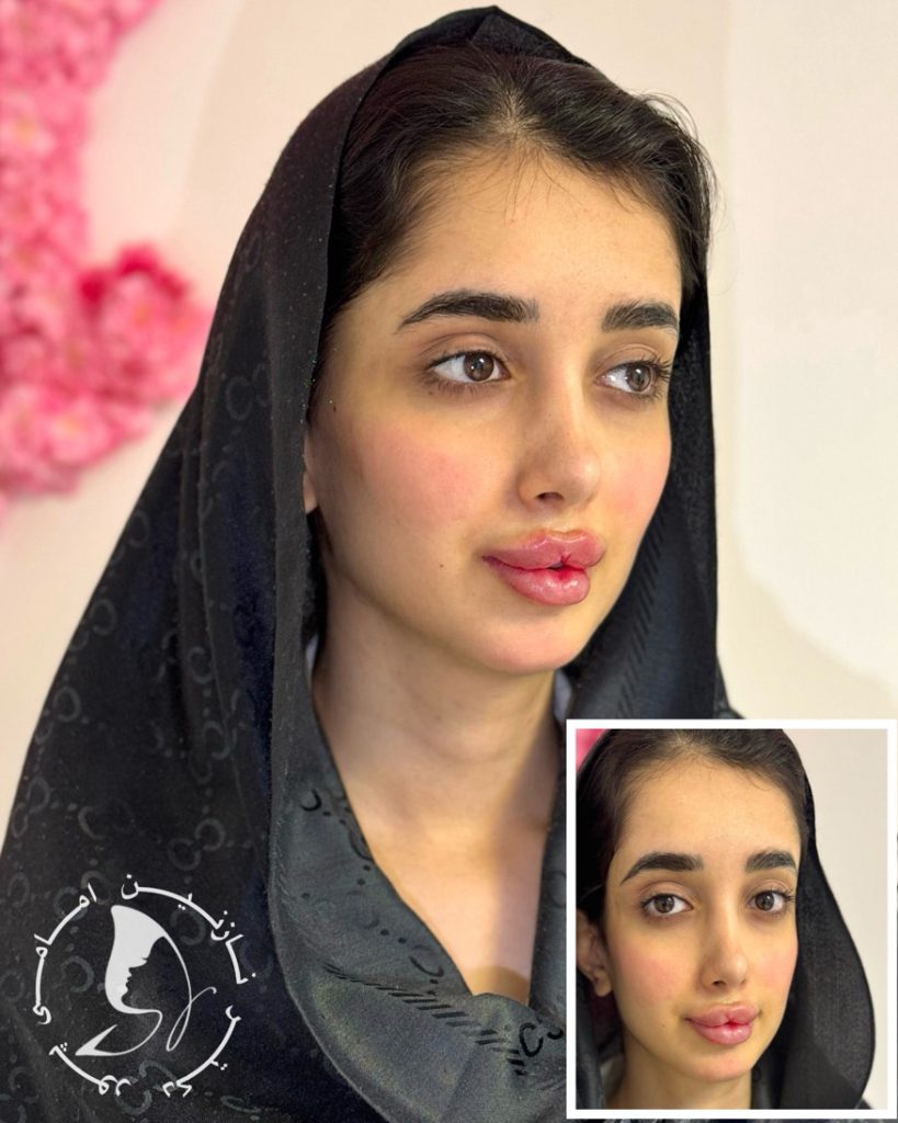 مدل لب روسی با ژل حجم‌دهنده