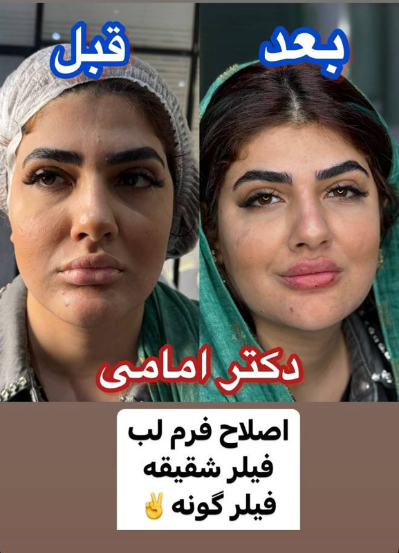 عکس کانتورینگ صورت شامل اصلاح فرم لب و تزریق فیلر شقیقه و فیلر گونه